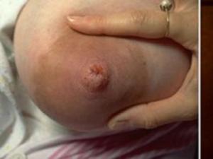 Стафилококк у грудных детей: симптомы, причины и лечение Золотистый стафилококк у ребенка 1 год симптомы